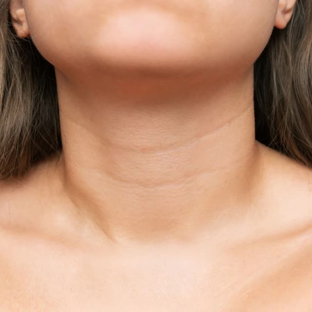 Zone 2: Neck CO2 Laser Skin Resurfacing