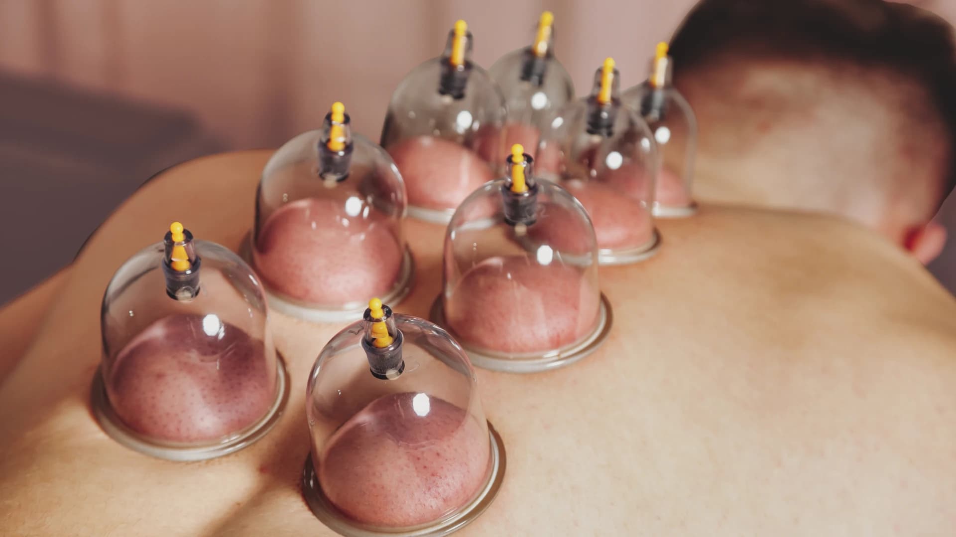 Cupping Massage in Nijmegen: Deep Muscle Relief & Detox | SkinSymphony